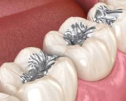 Ventajas y desventajas de la amalgama dental