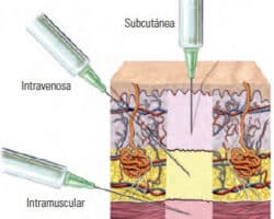 Ventajas y desventajas de la vía intravenosa