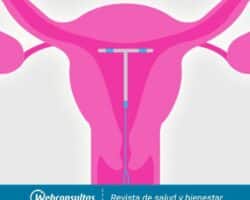 Ventajas y desventajas del dispositivo intrauterino (DIU).